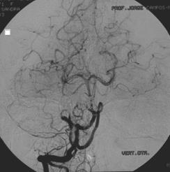 vertebral artery angiograms