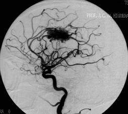 EMBOLIZATION - ONYX Lateral left
