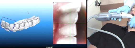 Capture the Buccal Segment of an Arch If you still have holes after you have used up your lingual pictures, you can try to compensate as you scan the buccal view.