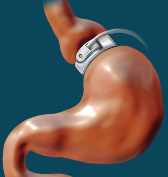 3. How Does It Work? Gastric band surgery We rarely perform gastric band surgery now. It was all the rage 5-10 years ago. It was a fairly safe operation.