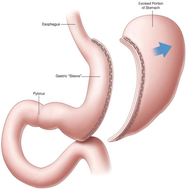 Sleeve Gastrectomy Patients like the procedure of sleeve gastrectomy, and it is not particularly complicated to perform. It is, however, a permanent procedure as a part of the stomach is removed.