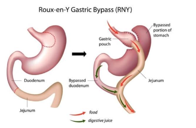 Gastric Bypass There are various types of gastric bypass. It is a more complicated procedure and takes longer to perform. It is a mixture of a restrictive and a malabsorptive procedure.