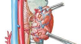 ENDOCRINE SURGERY ESOPHAGECTOMY Surgery is the most common treatment for esophageal cancer