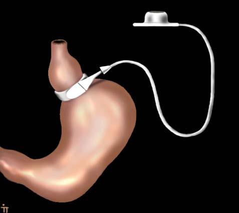 High Complication Rate after Swedish Adjustable Gastric Banding in Younger Patients 25 Years. Obesity Surgery 2008. 52% Complications -> Reoperation 40% BAROS Failure Rate Age < 25 years.