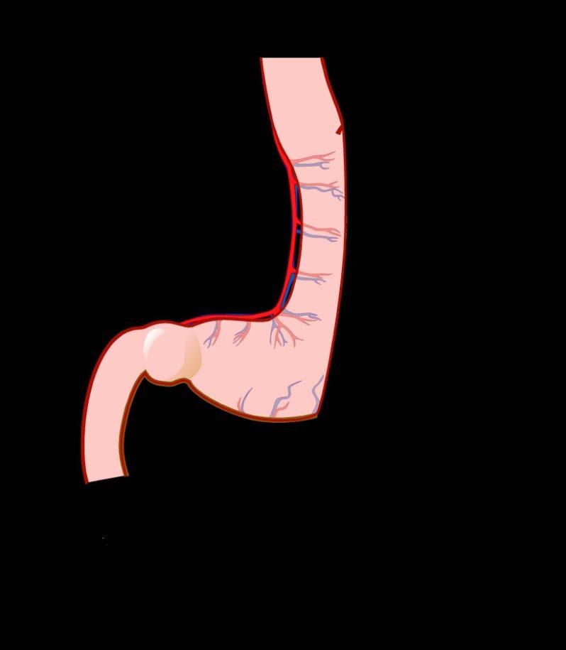 Sleeve Gastrectomy Metabolic Surgery (Decreased Ghrelin Levels & Reduces Appetite) Similar Excess Weight Loss and Resolution of Diabetes to RYGB Reduced