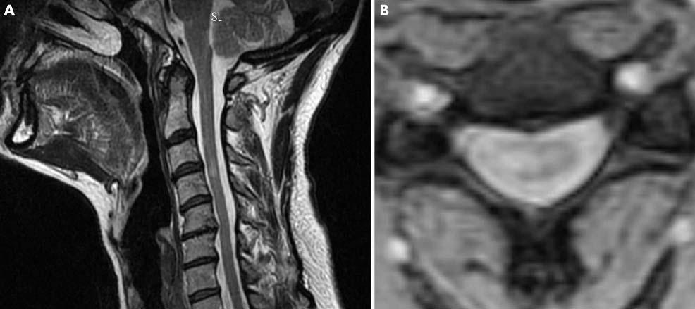 Figure 3 Cervial spine MRI of a 49 year old woman with a spinal ord linially isolated syndrome (CIS) demonstrating a lesion at C3/4 on (A) sagittal imaging and (B) axial imaging whih shows that the