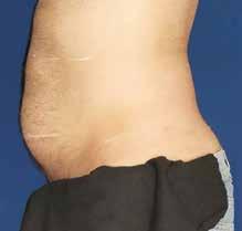 The unit is cleared for temporary reduction of cellulite, but with the bi-polar RF I think there is a potential for long-term remodeling.