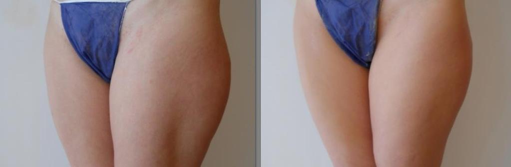 Before Skin texture improvement; cellulite reduction;