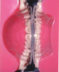 anterior teeth Keeps lower anteriors from hitting lingual surface of uppers Protects upper