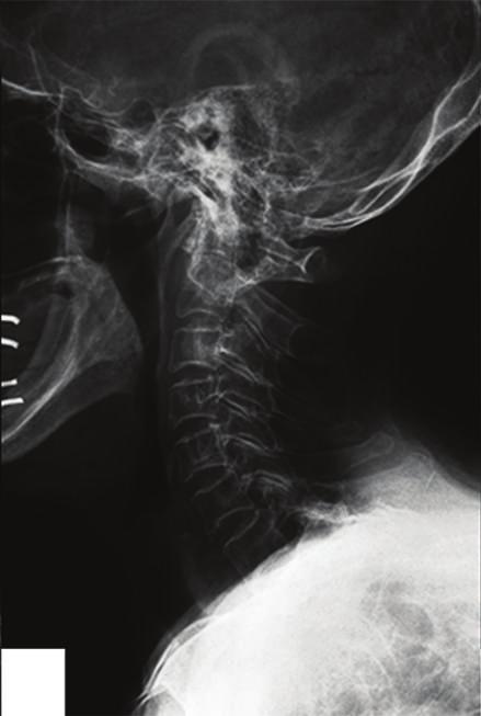 Lateral standard radiographs of thoracolumbar spine revealed marked thoracic kyphotic deformity due to multiple compression fractures (c).