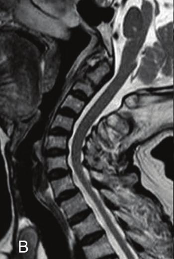 Halo-vest fixation. Conservative treatment with Philadelphia type cervical caller was indicated.