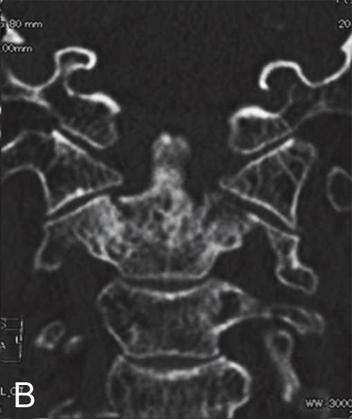 the axis body; and type III fractures extend deep through the cancellousportionofthebodyofaxisatthebaseofthedens. In elderly individuals, odontoid fractures are not uncommon [1, 2].