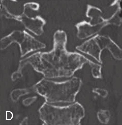 Odontoid fractures are mostly induced by nonphysiological flexion, extension, or rotation force of the upper cervical spine; however exact mechanism is not fully determined [3, 11].