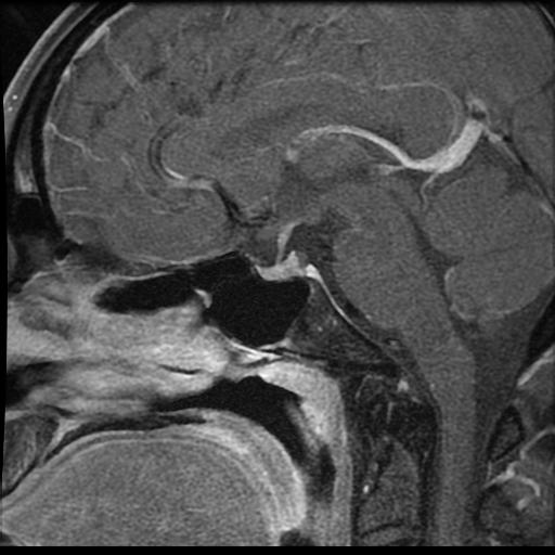 MRI Pituitary gland moderately atrophic with