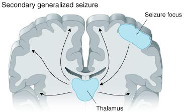 Secondary generalization of partial seizures For sufficiently strong focal activity - spread to neighboring regions of the