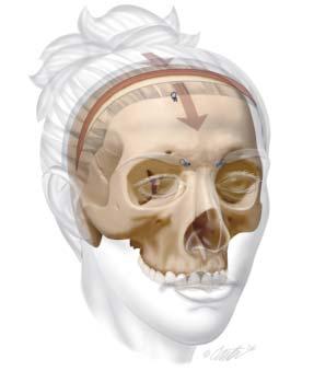 Figure 2. Overview of brow repositioning procedure. t the site of the coronal incision and the present hairline, the skull is marked with a drill for later reference.