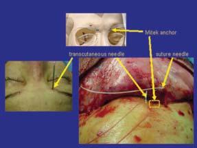Mitek anchor Transcutaneous needle Suture needle Figure 3. Detail of medial brow fixation.