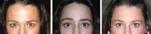 C Figure 5., Preoperative view of the 33-year-old woman shown in Figure 1., Postoperative view 1 year after endoscopic brow and midface lift and upper and lower lid blepharoplasty.