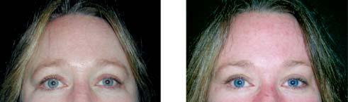 , Preoperative view of a 43-year old woman who had undergone endoscopic brow and midface lift 2 years previously.
