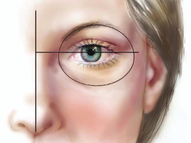 medial canthus; (3) the eyebrow should rise gently with a peak at least two-thirds of the way to its lateral end; (4) the lateral tail of the brow should be higher than the medial end; and (5) the
