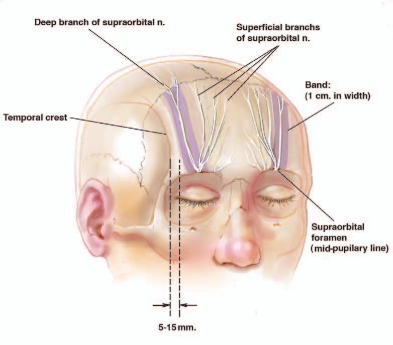 Deep branch of supraorbital n. Superficial branches of supraorbital n. and: (1 cm in width) Temporal crest Supraorbital foramen (mid-pupilary line) 5-15 mm. Figure 8.