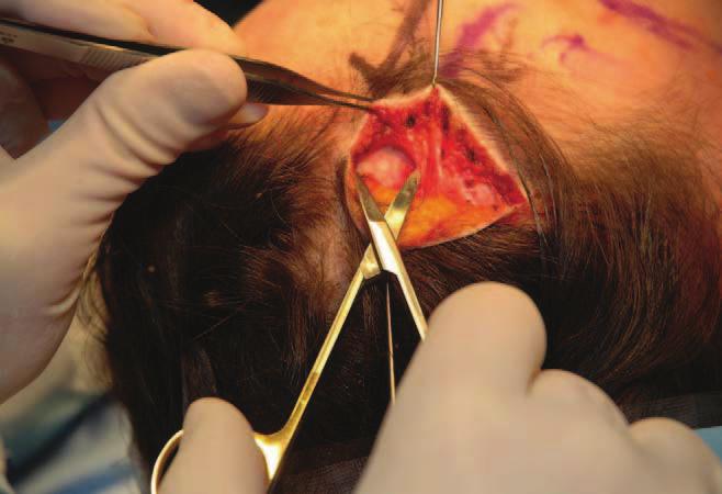 Figure 11. The incision is marked along with the planned excision of full thickness scalp.