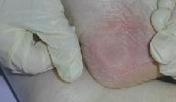 indicate patient at risk GRADE 2 Partial thickness loss of dermis
