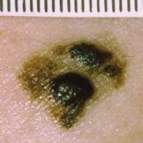 Anyone can develop skin cancer, but some people are at more risk, especially those who have fair skin, hair and eyes, lots of moles or