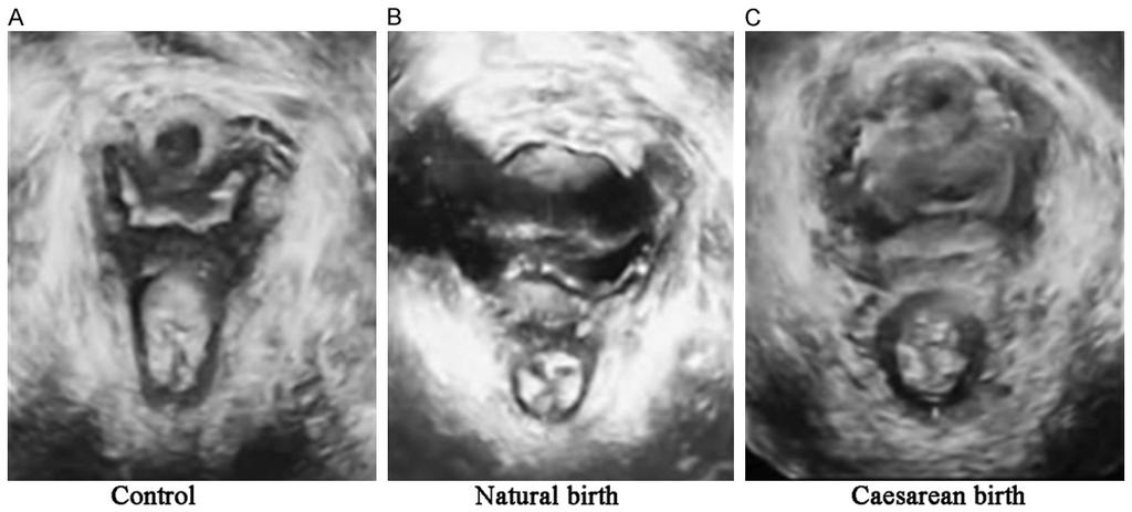 Figure 1. 3D ultrasound images of all patients. recovery of uterine after surgery was satisfactory.