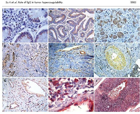 FGL2 AND CANCER Fgl2 mrna is expressed in a wide variety of human tumor tissues and in interstitial inflammatory cells such as macrophages and vascular endothelial cells.