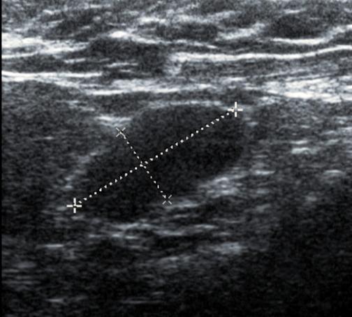 A left mediolateral oblique view mammogram confirms gynaecomastia with a diffuse glandular pattern.