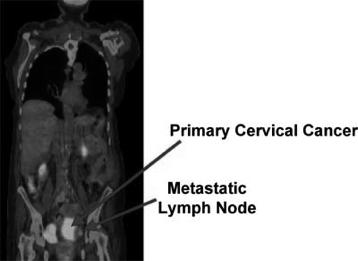 meta analysis of 25 studies looking at the sensitivity and specificity of PET scan to detect occult retroperitoneal LN metastases in early stage cervical cancer - Pooled