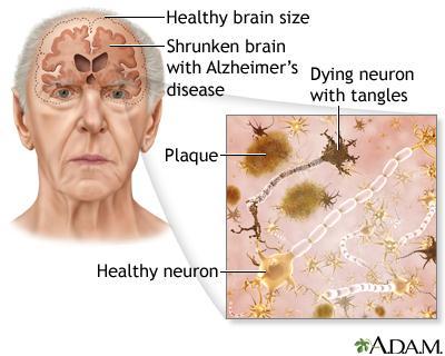Alzheimer s disease overview