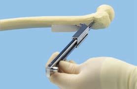 Should a neutral position be desired, the chisel guide should align with the femoral shaft.