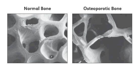 Reports n Figure. Normal Versus Osteoporotic Bone 16 Normal Bone Osteoporotic Bone most commonly occur at sites that are rich in trabecular bone, such as the spine, wrist, and hip.