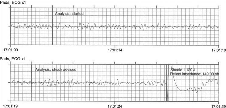FIGURE 1. Initial electrocardiogram (ECG) showing ventricular fibrillation and the first shock from the first responder automated external defibrillator.