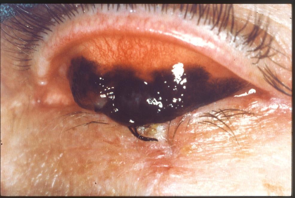 Tumors of the conjunctiva: orphan diseases non-hodgkin lymphoma malignant melanoma squamous cell carcinoma extremely