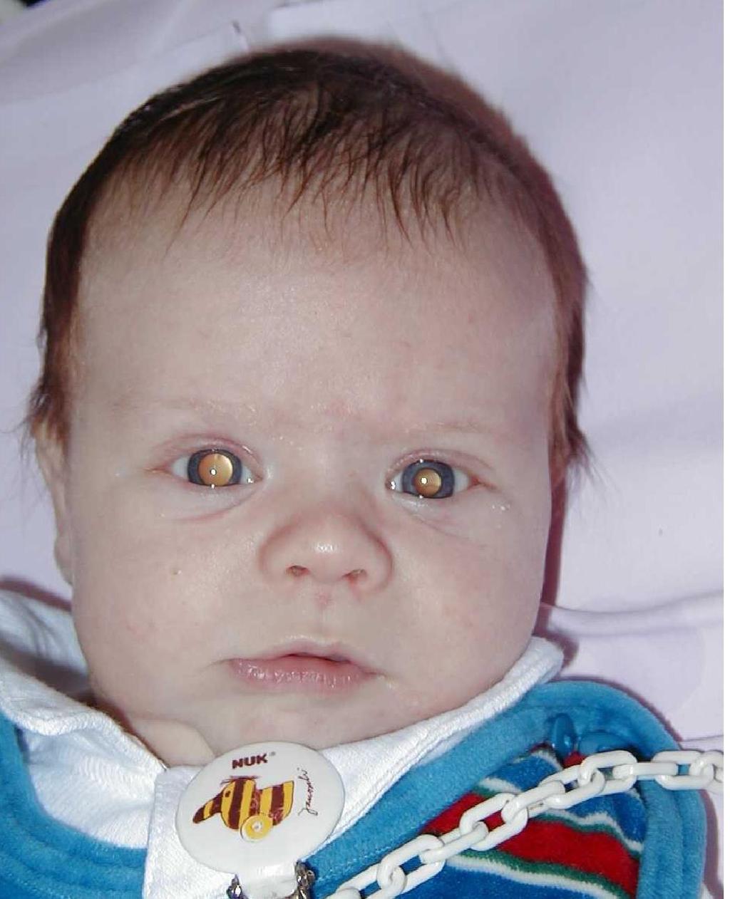 Bilateral retinoblastoma very young children multiple tumors in both eyes hereditary