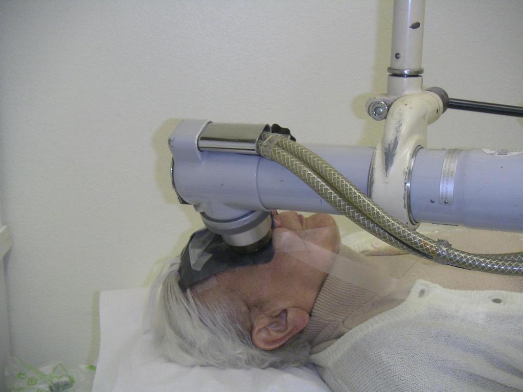 Ophthalmic tumors: Irradiation techniques External beam