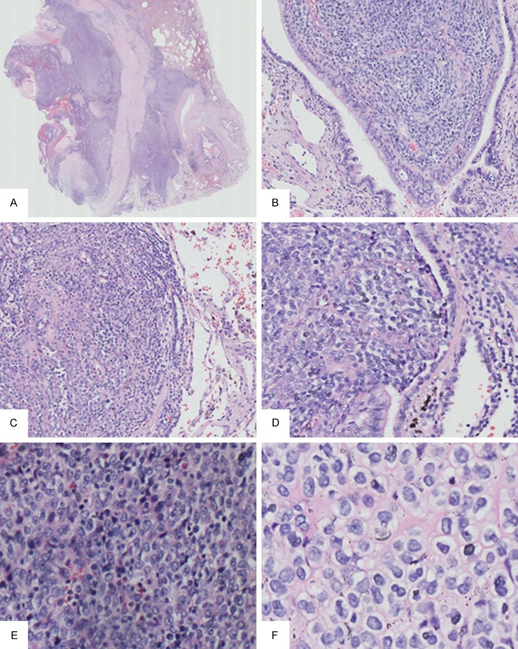 Figure 1. Morphological change of the tumor. A. The tumor was not well circumscribed with central hemorrhaging and peripheral infiltration into the normal lung tissue. B.