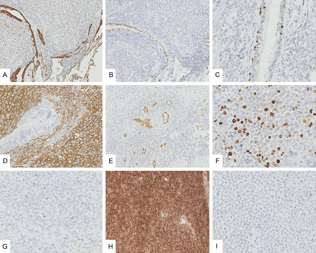 Figure 2. Immunohistochemical staining of the tumor. A. The tumor cells were negative for CK, whereas the destroyed and the remaining epithelia cells were positive for CK. B.