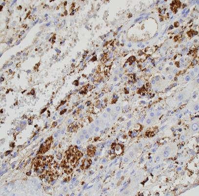 Undifferentiated sarcoma, tumor edge with growth along sinusoids PASD + globules Also Alpha-1-antitrypsin + Undifferentiated Embryonal Sarcoma Problem with
