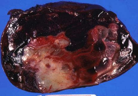 seen. Hemangioma-like vessels (HLV) in adjacent liver commonly seen with