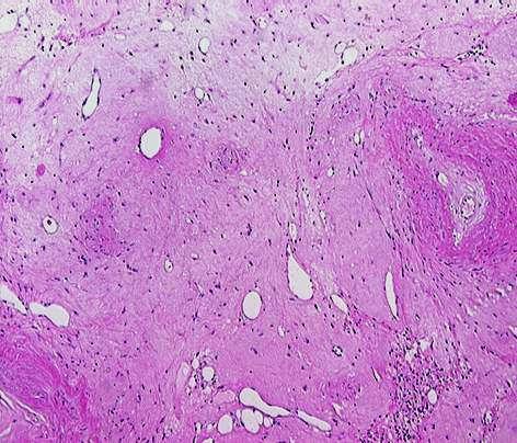 Hepatic Cavernous Hemangioma: Under-Recognized Associated Histologic