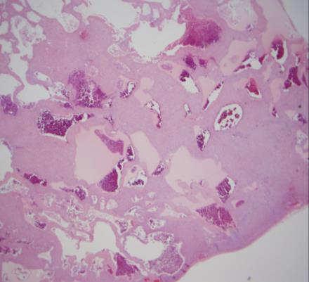 Cavernous Hemangioma Variant Diagnoses: Giant Cavernous Hemangioma and Cavernous Hemangiomatosis