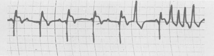 The blackened area is the period of electrical interference. There is no malfunction of the pacemaker. Animal TABLE 1.
