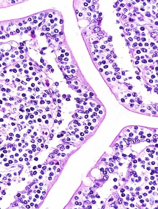 Monomorphic epitheliotropic intestinal T-cell lymphoma (EATL II) Medium sized cells