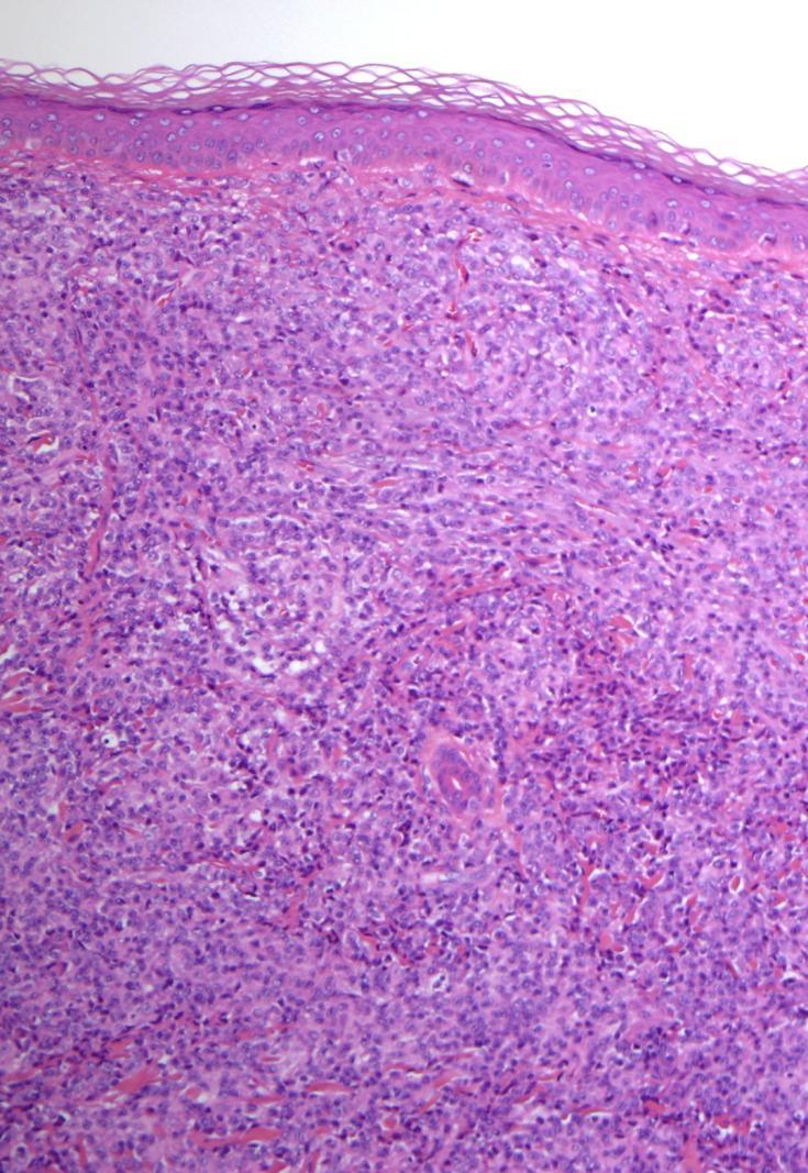 Primary cutaneous acral