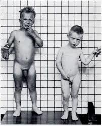 Max points : 3 14 The boys on the picture are 2½ old. One of them suffers from adrenogenital syndrome (congenital adrenal hyperplasia).
