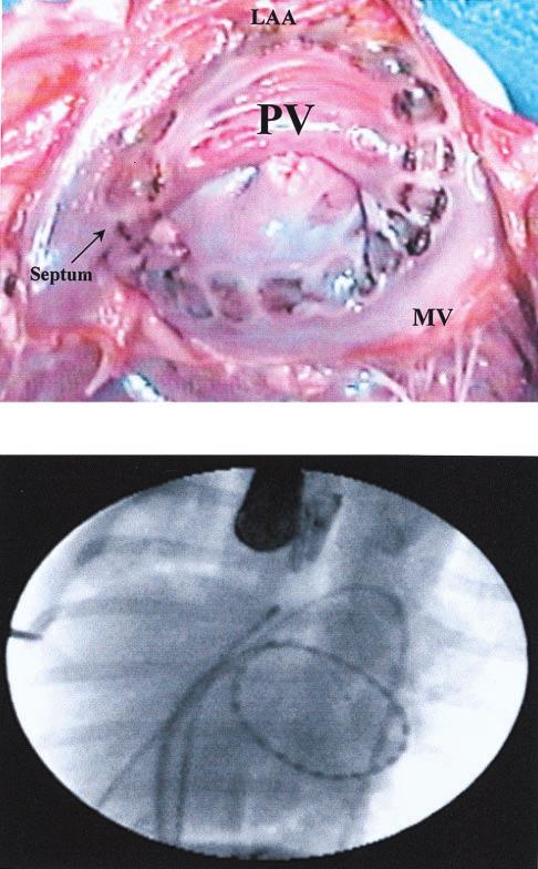 JACC Vol. 33, No. 4, 1999 March 15, 1999:972 84 Avitall et al. Linear Lesion Creation 981 Figure 8. Left atrial horizontal position: gross lesions with charring and fluoroscopic image.